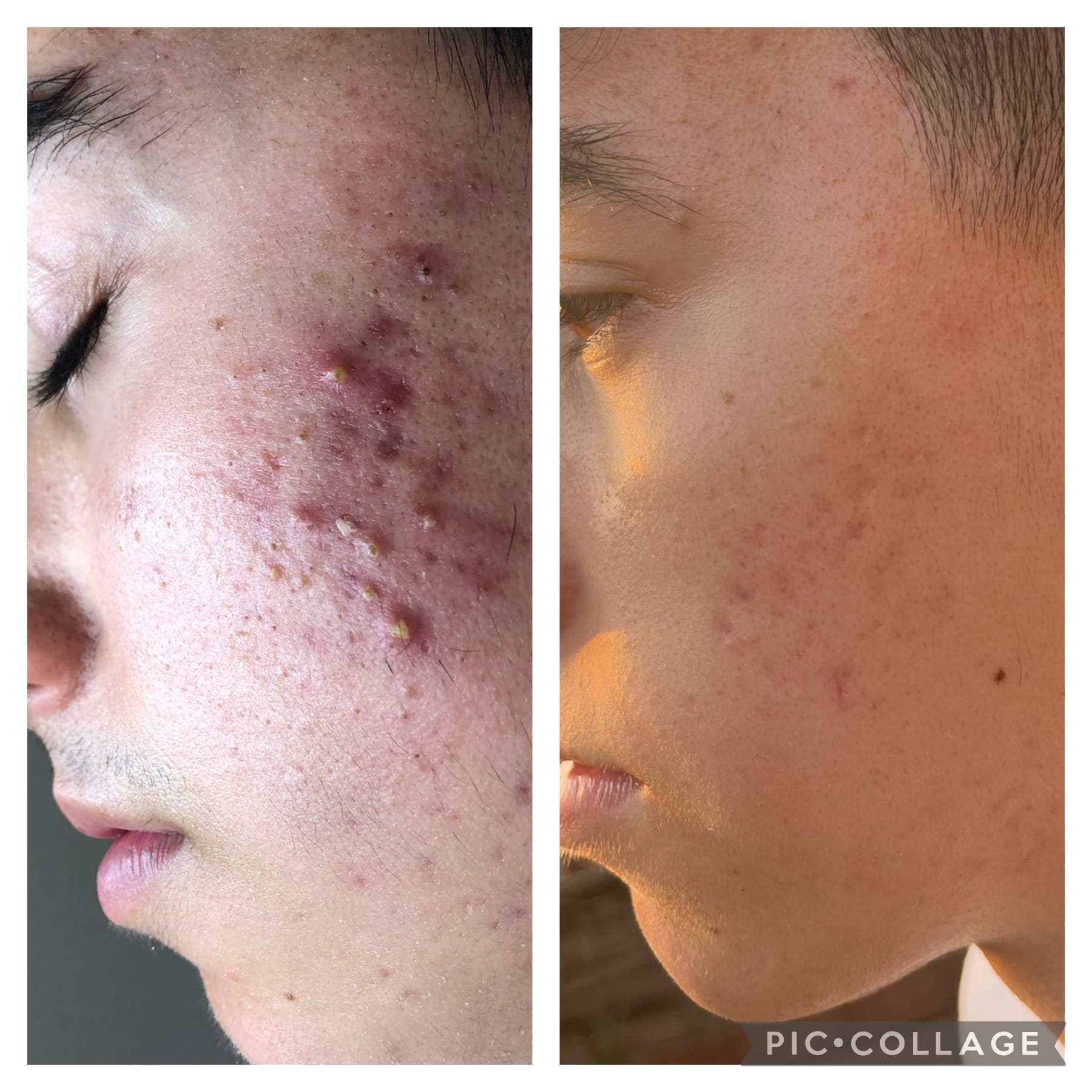 Side by side photographs of a cheek before and after using the Lakshmi KAPHA line