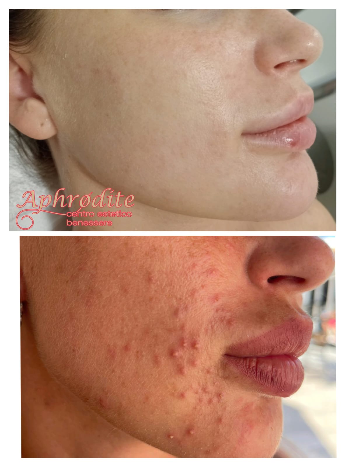 Before and after photos of cheek skin